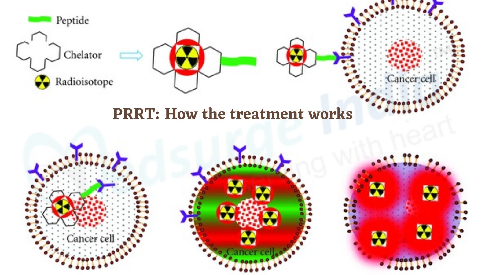 PRRT: How The Treatment Works