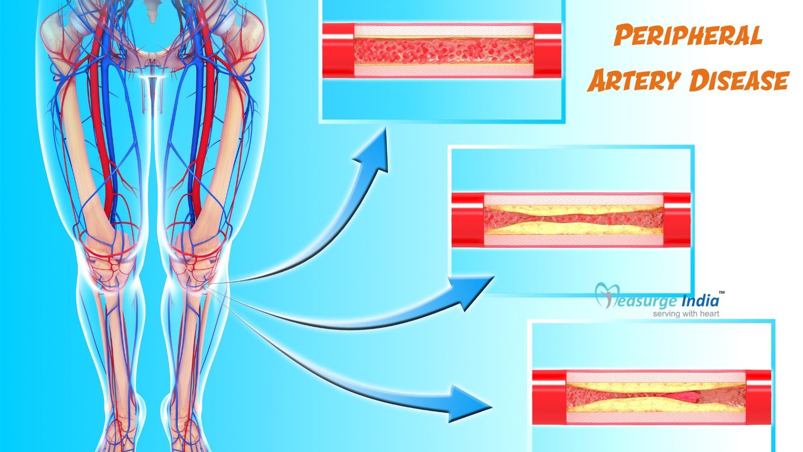 peripheral-artery-disease-causes-symptoms-treatment