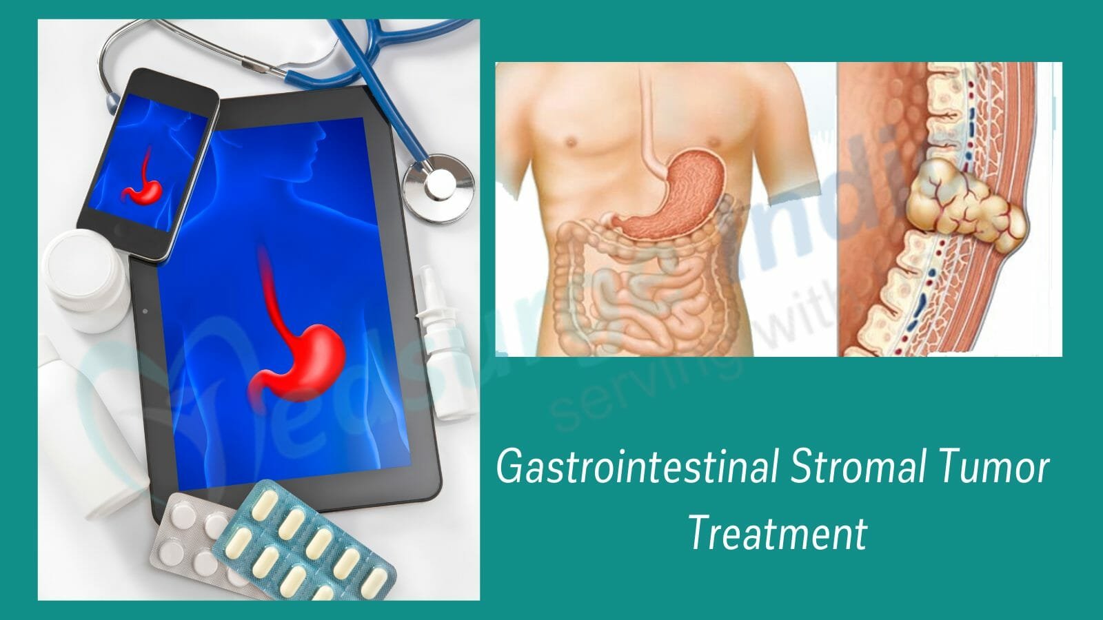 Gastrointestinal Stromal Tumor Treatment Cost in India
