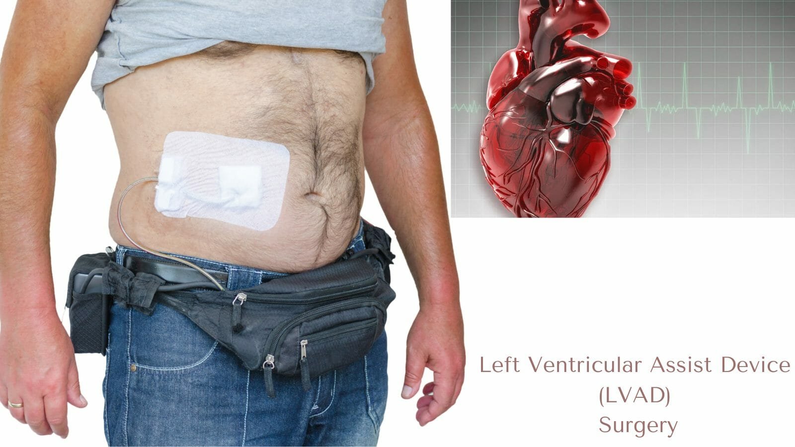 What Is The Most Common Type Of Ventricular Assist Device