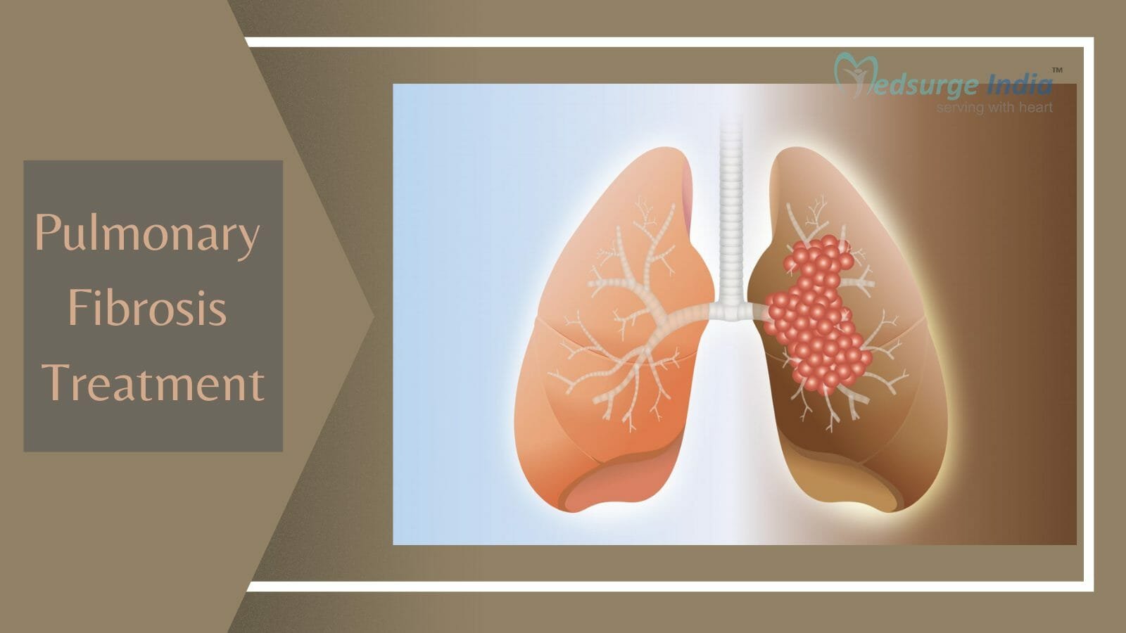 Pulmonary Fibrosis Treatment Cost in India