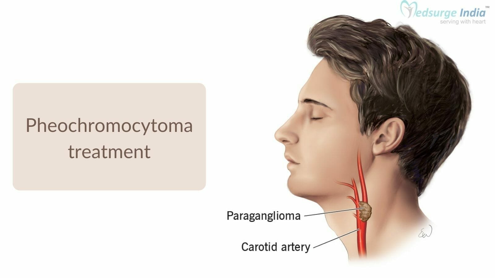 Pheochromocytoma Treatment Cost In India