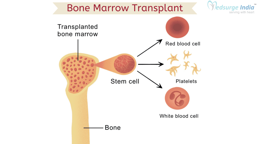 Bone Marrow Transplant in Bangalore