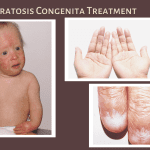 Dyskeratosis Congenita Treatment Cost In India