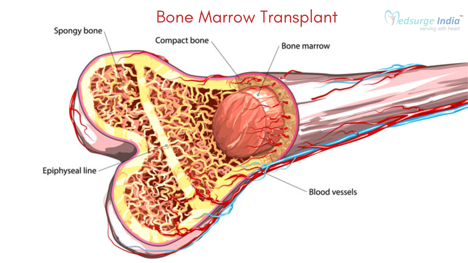 Bone Marrow Transplant in india