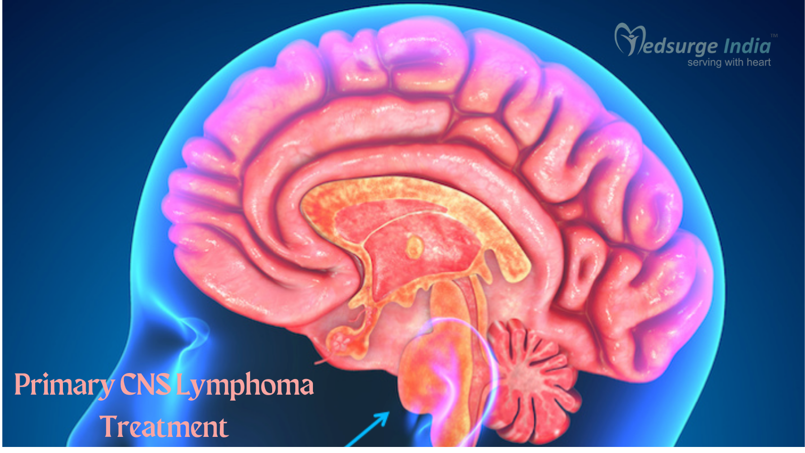 primary-cns-lymphoma-treatment-cost-in-india-medsurge-india