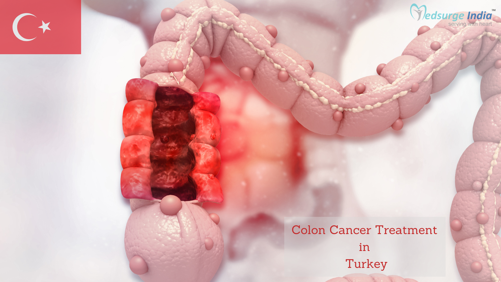 Colon Cancer Treatment Cost In Turkey
