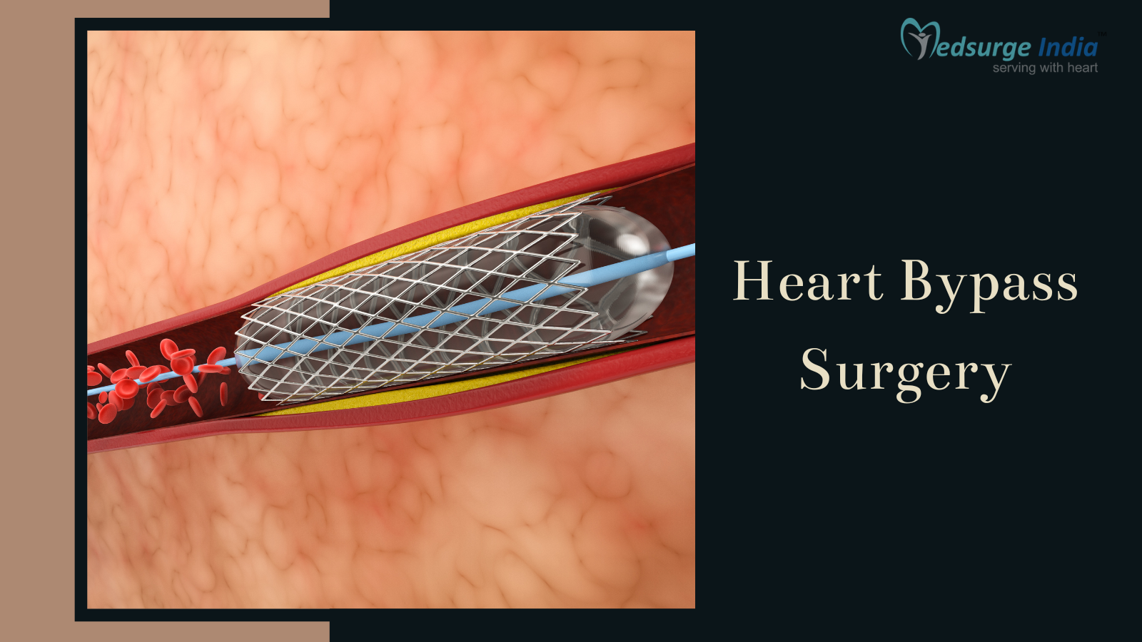 Heart Bypass Surgery Cost in Delhi
