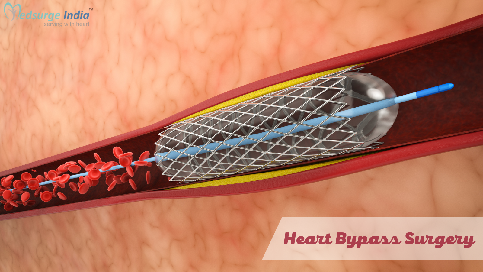 Heart Bypass Surgery Cost in Mumbai