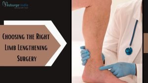 Choosing The Right Limb Lengthening Surgery: Femur Lengthening vs Tibia Lengthening