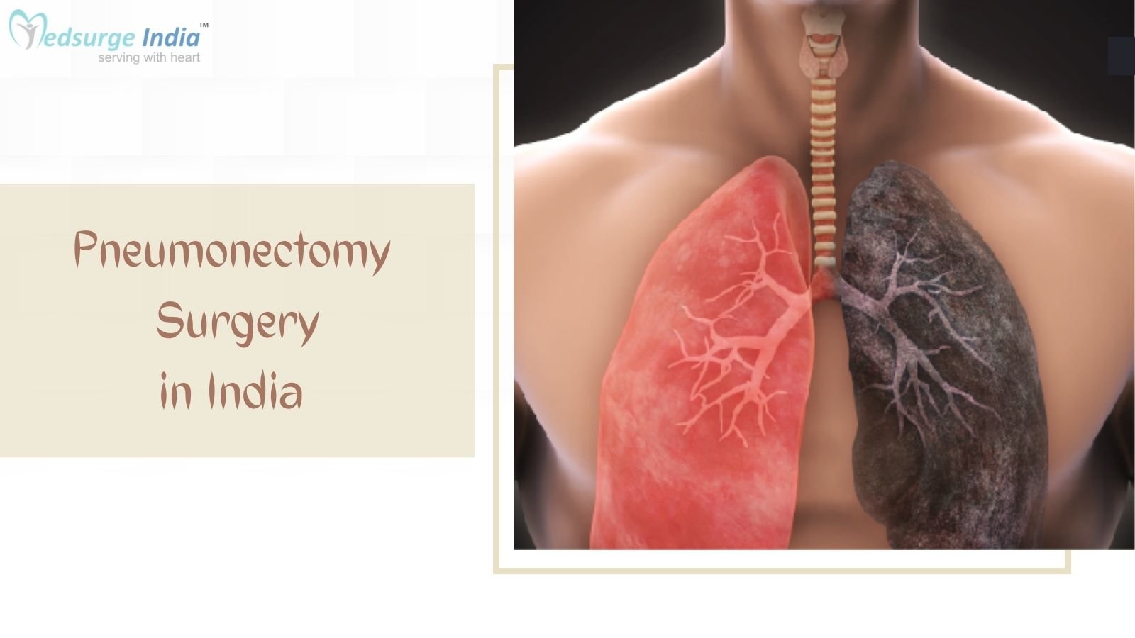 Pneumonectomy Surgery Cost in India