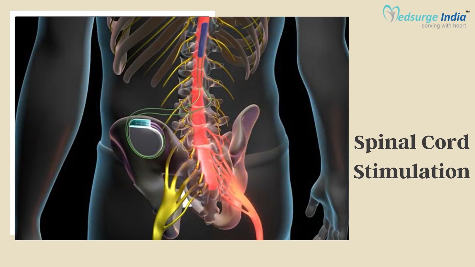 Spinal Cord Stimulation Cost In India