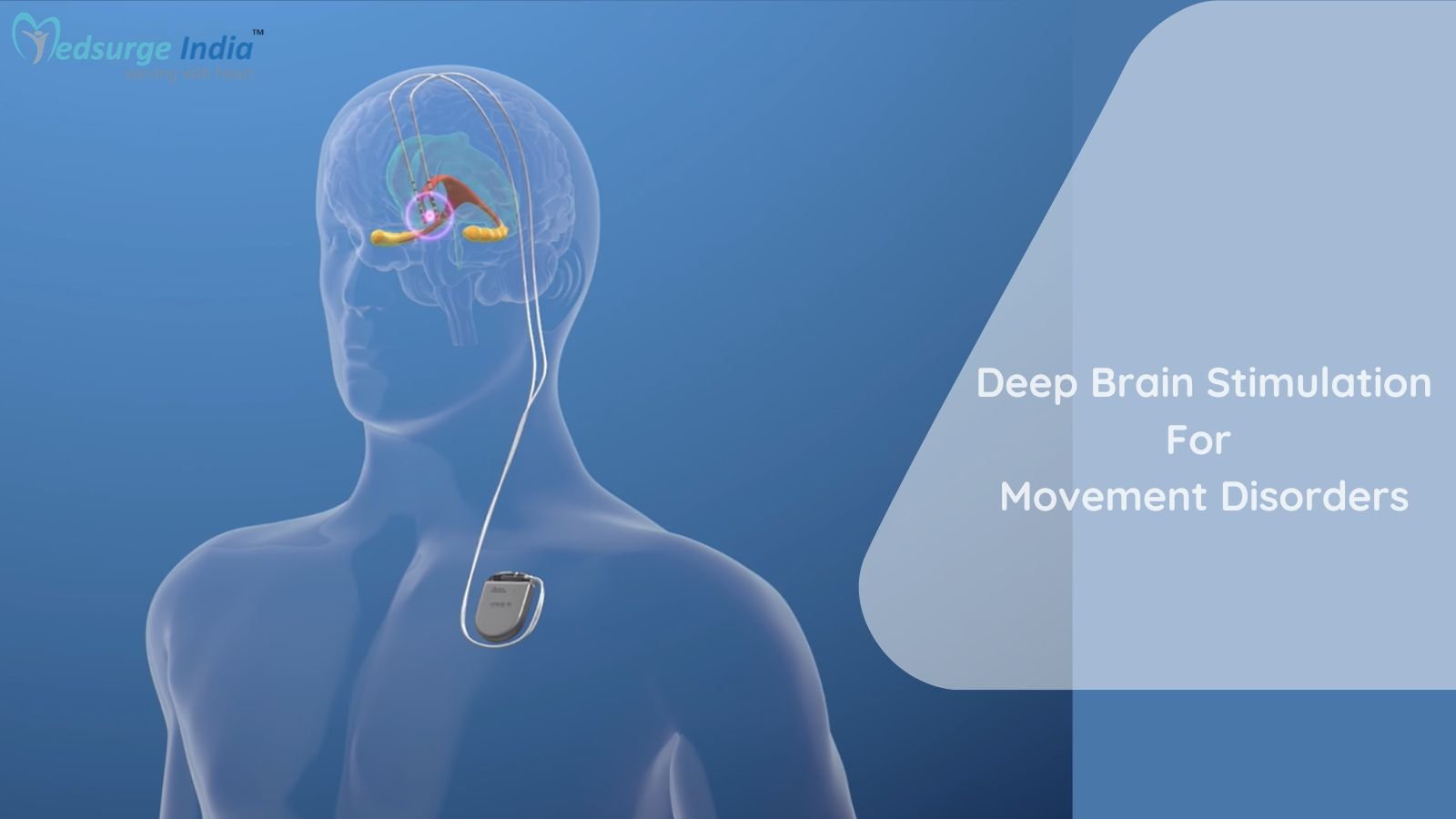 Deep Brain Stimulation For Movement Disorders