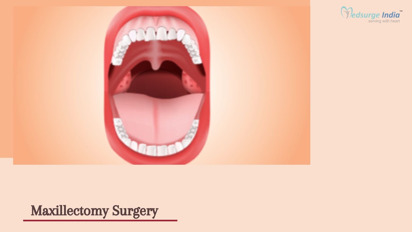 Maxillectomy Surgery Cost in India