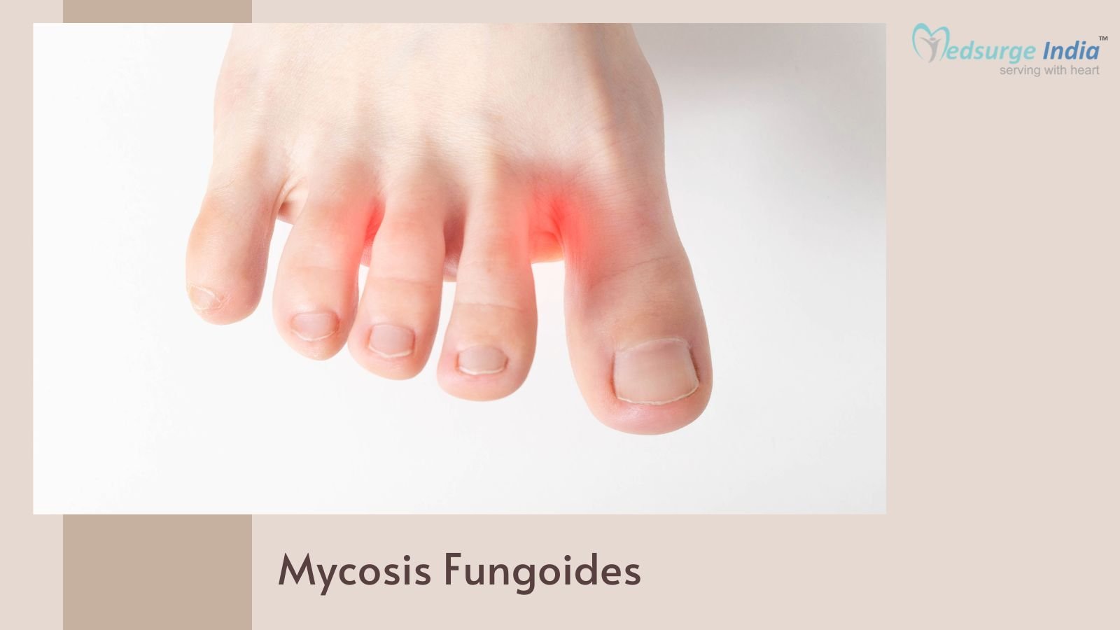 Mycosis Fungoides: Symptoms, Causes & Treatment