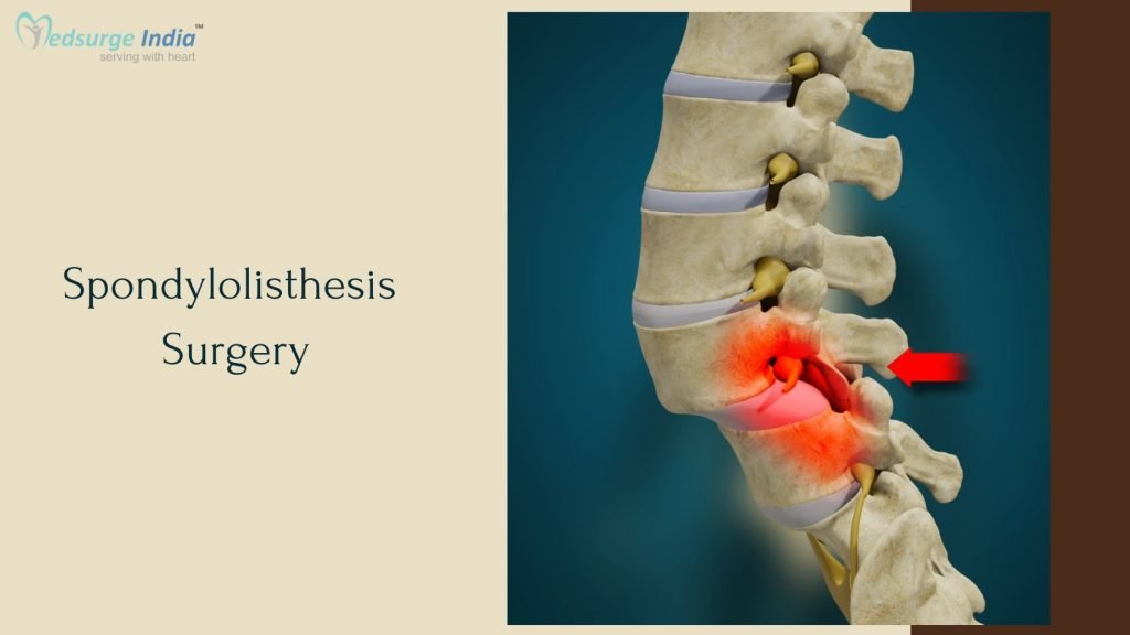 spondylolisthesis-surgery-cost-in-india