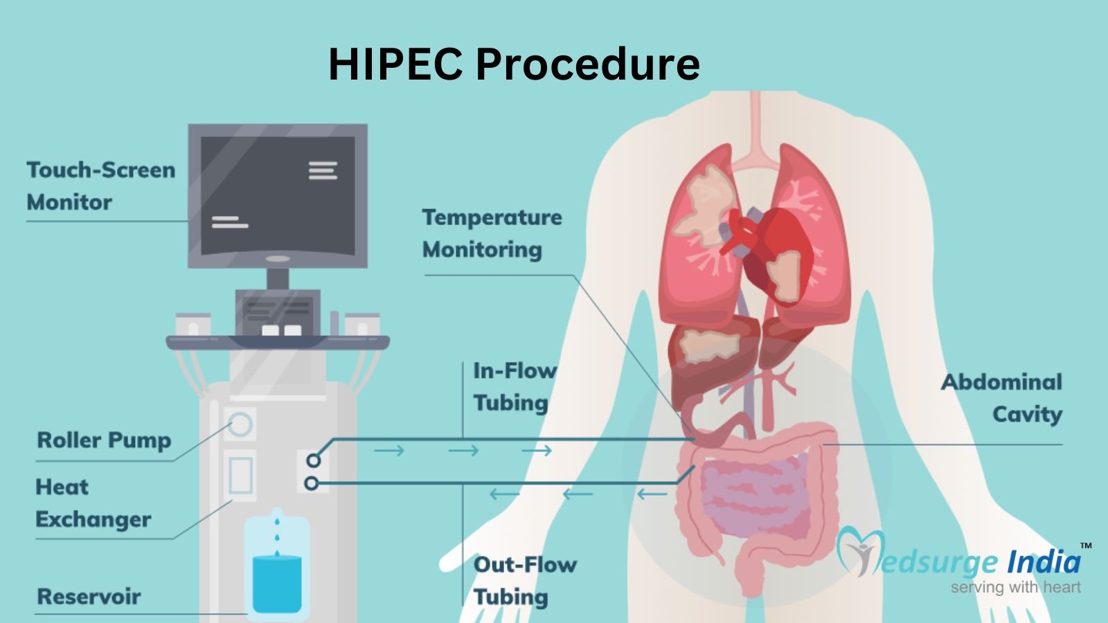 HIPEC Procedure