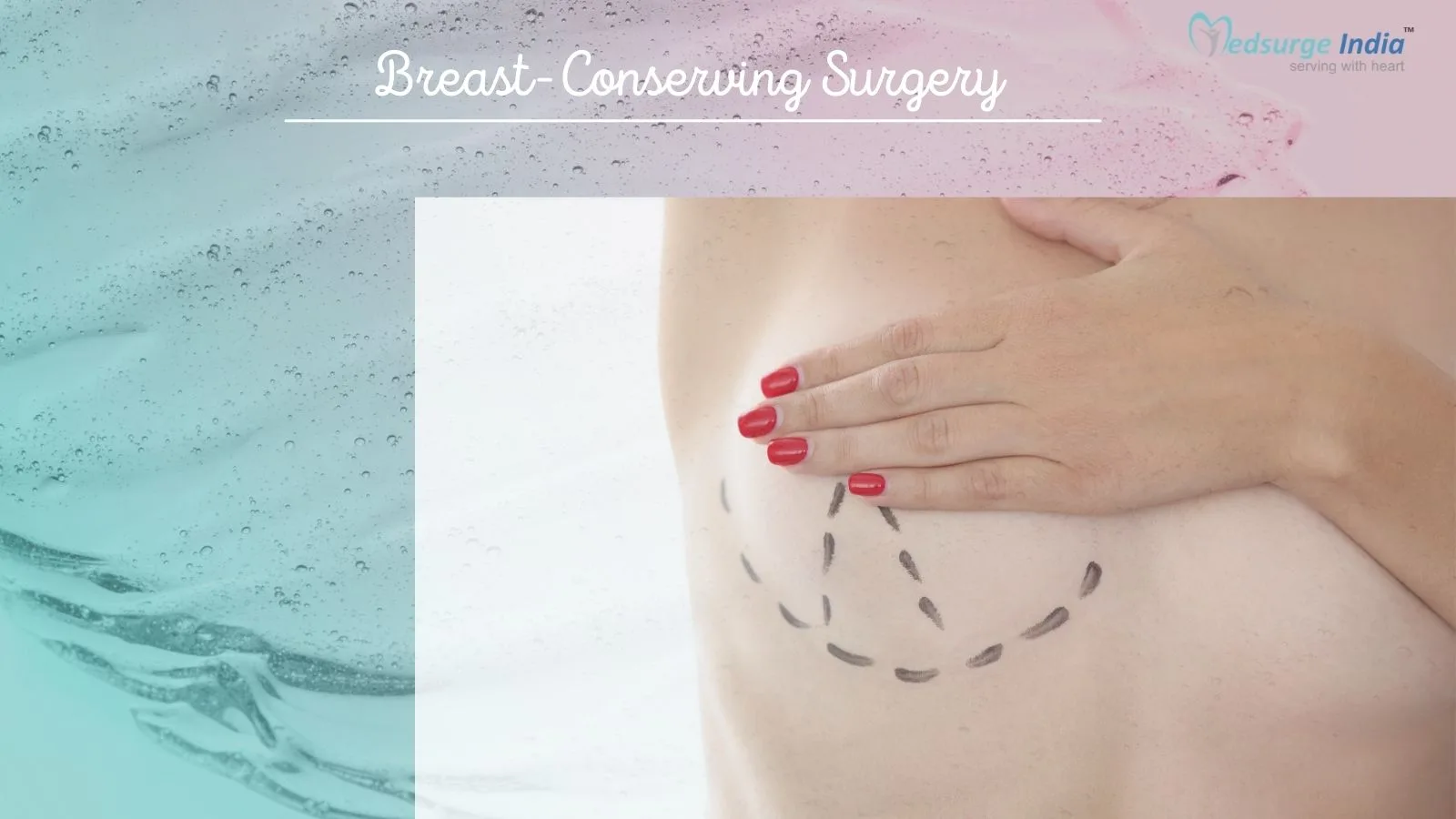 Breast Conserving Surgery