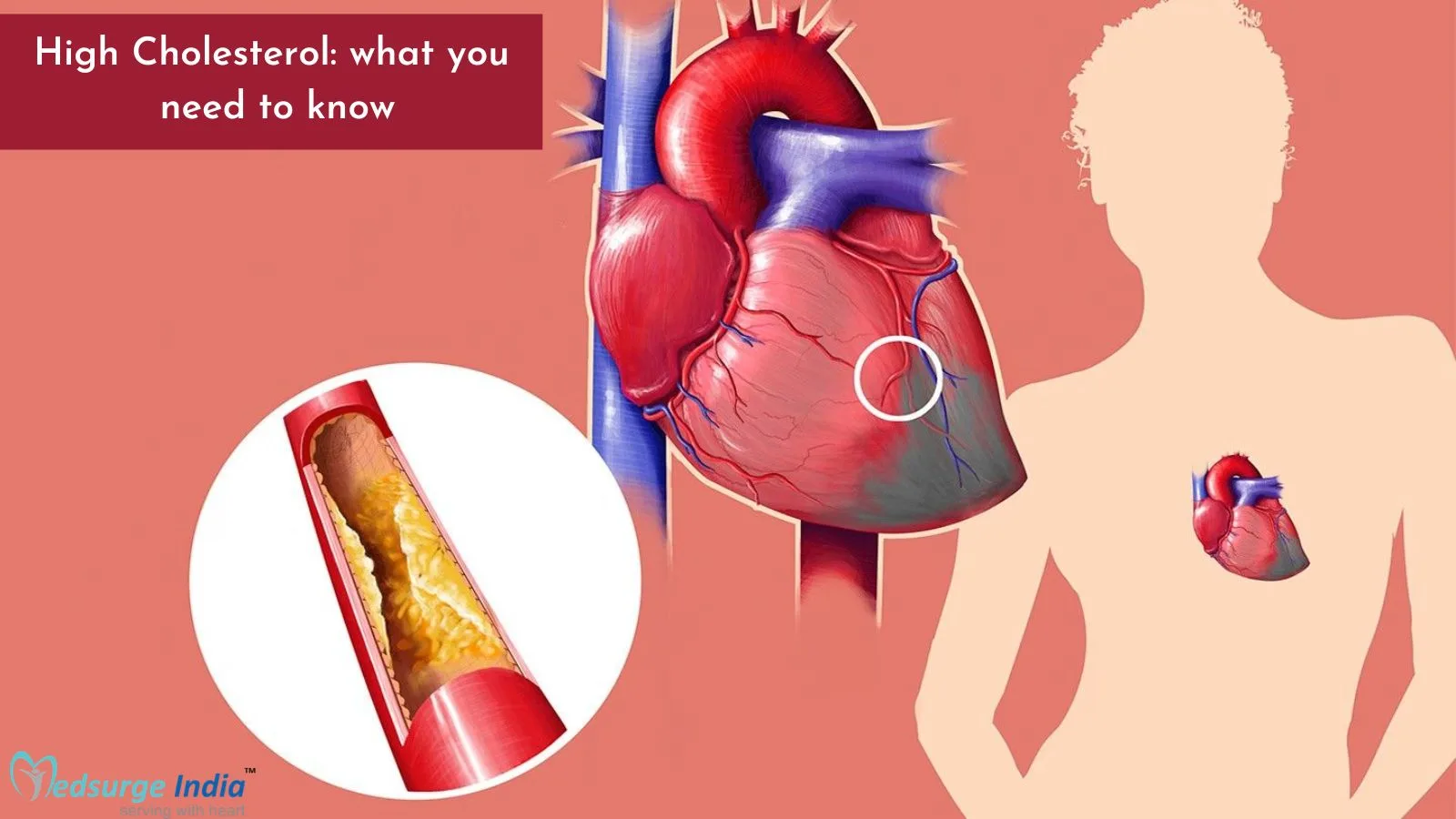High Cholesterol: What You Need to Know