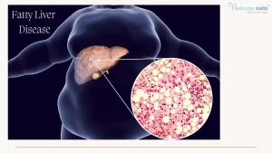 fatty liver disease