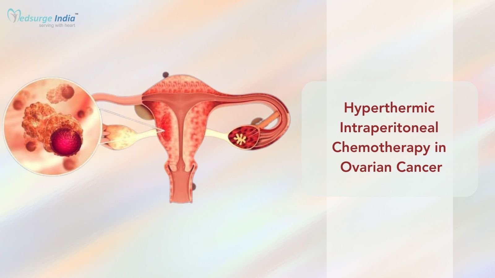 Hyperthermic Intraperitoneal Chemotherapy in Ovarian Cancer