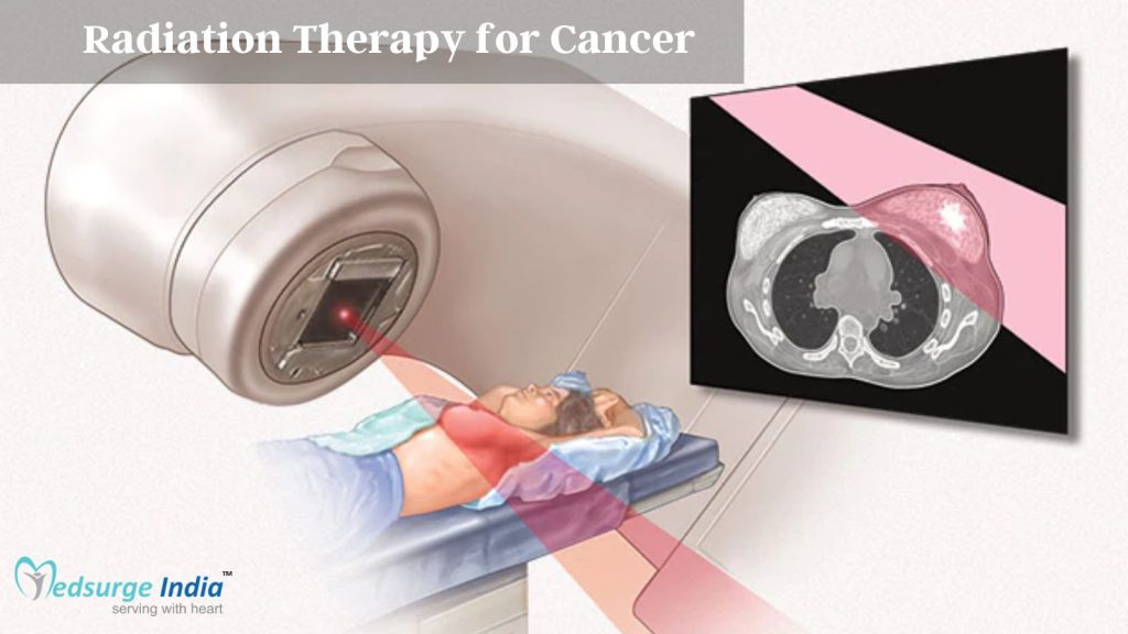 Radiation Therapy for Cancer