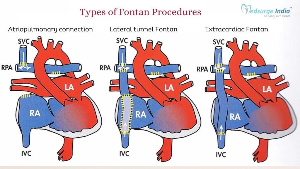 Types of Fontan Procedures