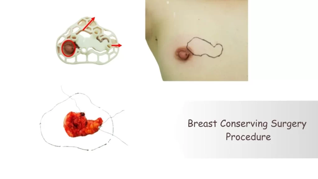 Breast Conserving Surgery Procedure