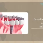 Dental Implants Cost in India