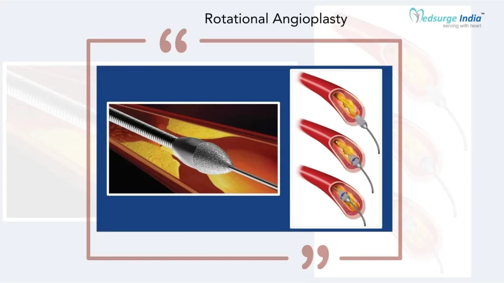 rotational-angioplasty-cost-in-india