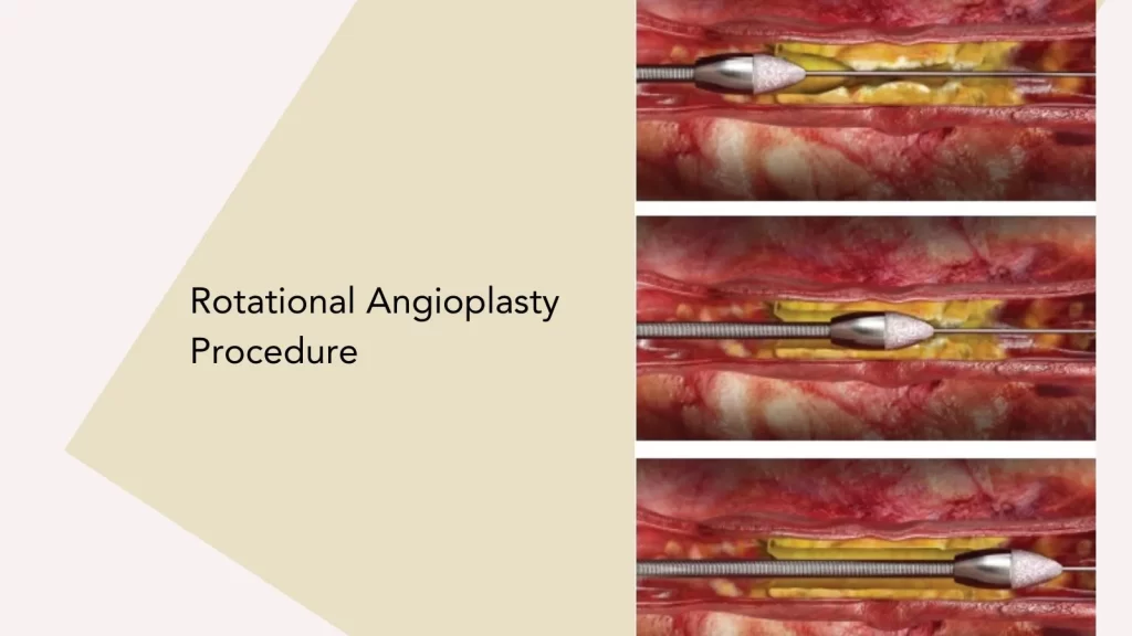 Rotational Angioplasty Procedure