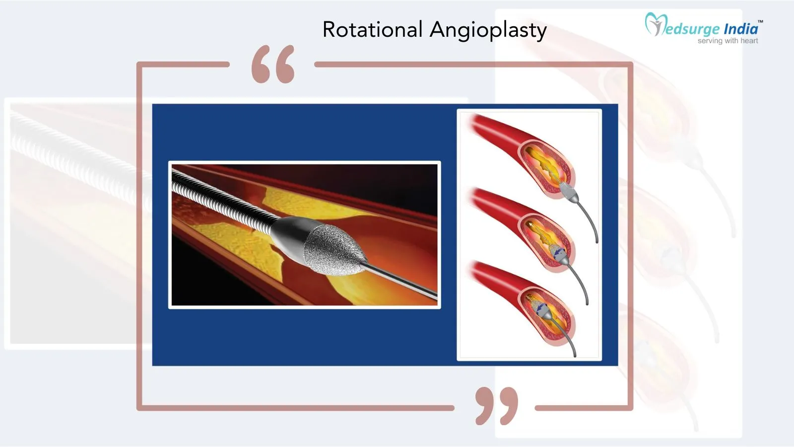 Rotational Angioplasty Cost in India