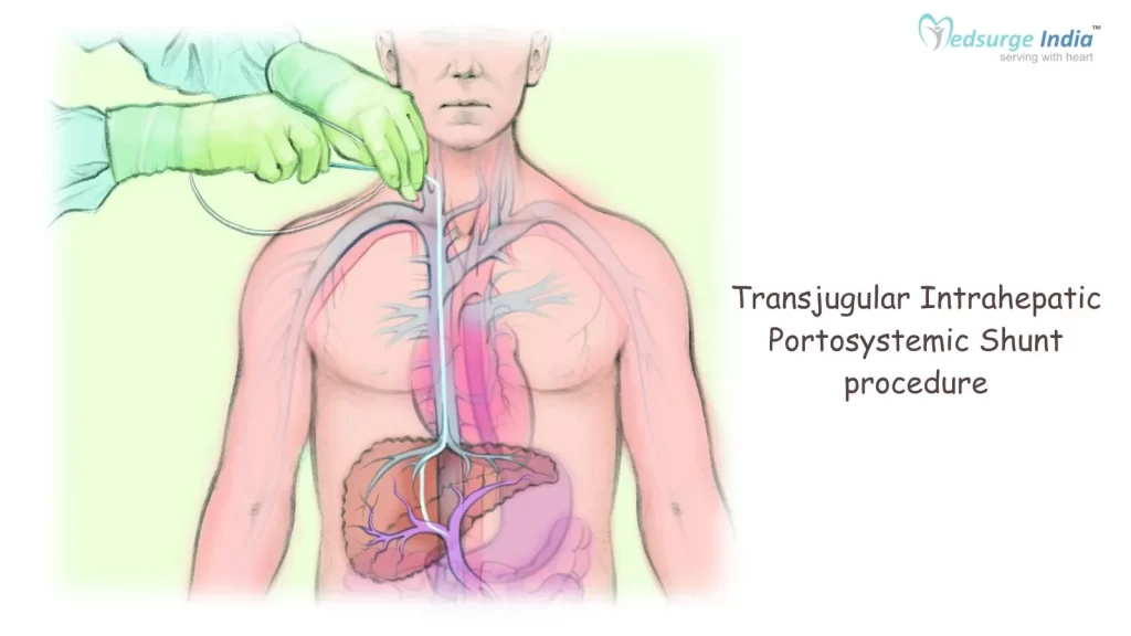 Transjugular Intrahepatic Portosystemic Shunt procedure