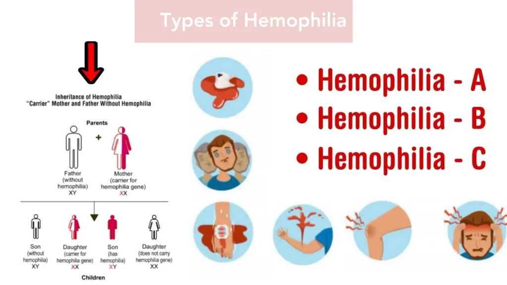Types of Hemophilia