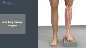 limb lengthening surgery