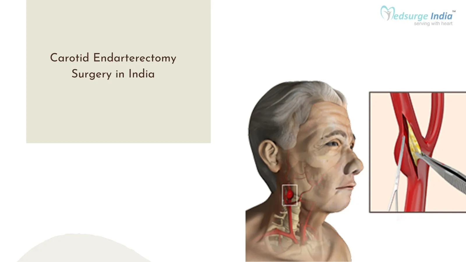 Carotid Endarterectomy Surgery Cost in India