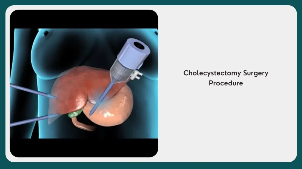 Cholecystectomy Surgery Procedure