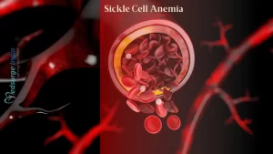 Sickle Cell Anemia types