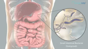 SIBO (Small Intestinal Bacterial Overgrowth)
