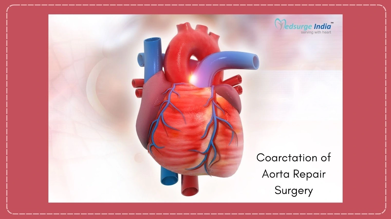 Coarctation Of Aorta Repair Surgery Cost In India | Procedure ...