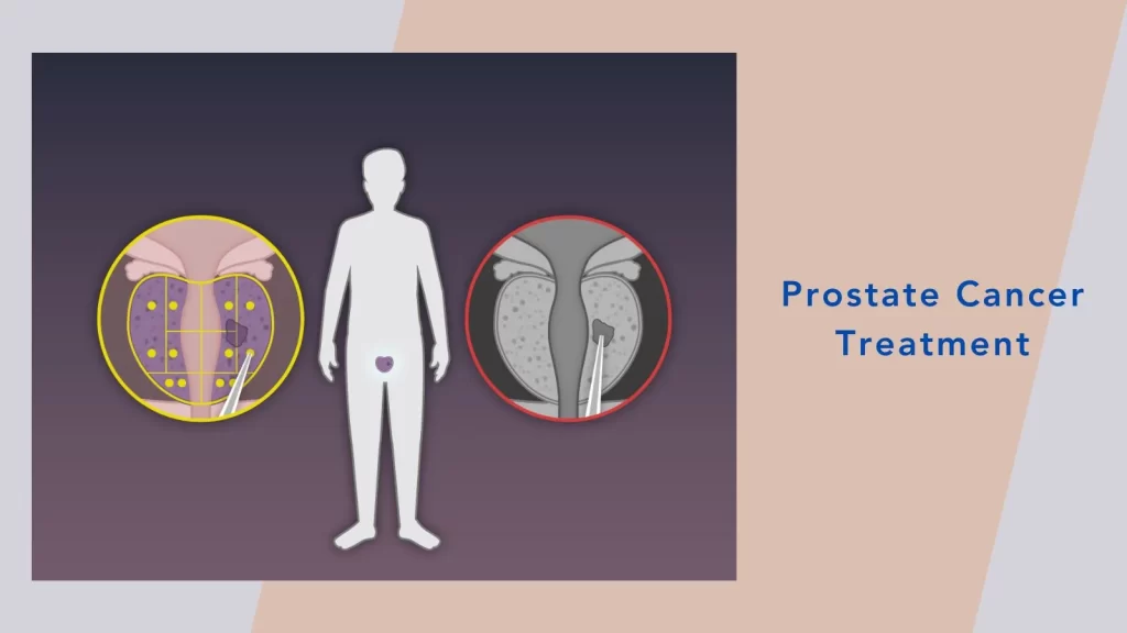 PSMA PET/CT Scan Enhances Prostate Cancer Treatment