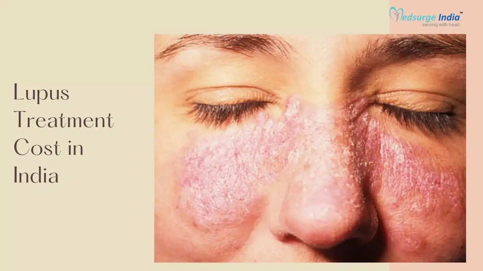 Lupus Treatment Cost in India