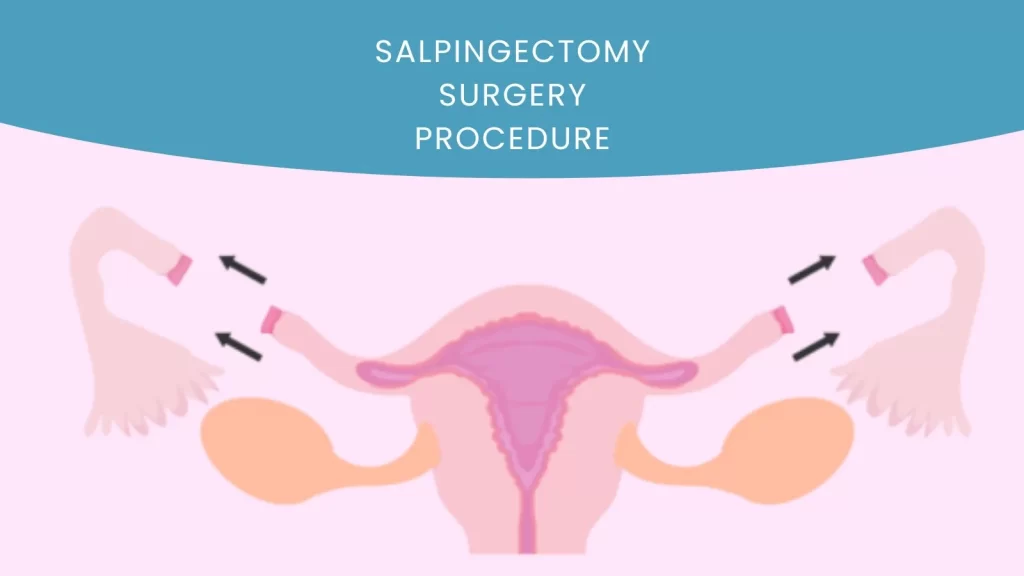 Salpingectomy Surgery Procedure