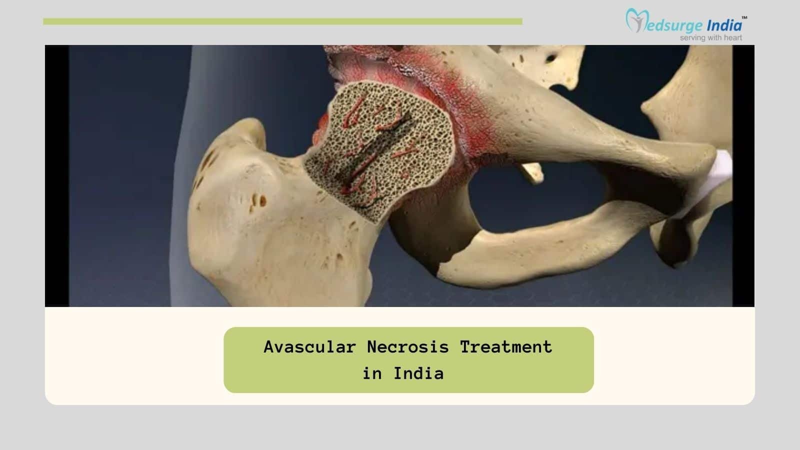 Avascular Necrosis Treatment Cost in India