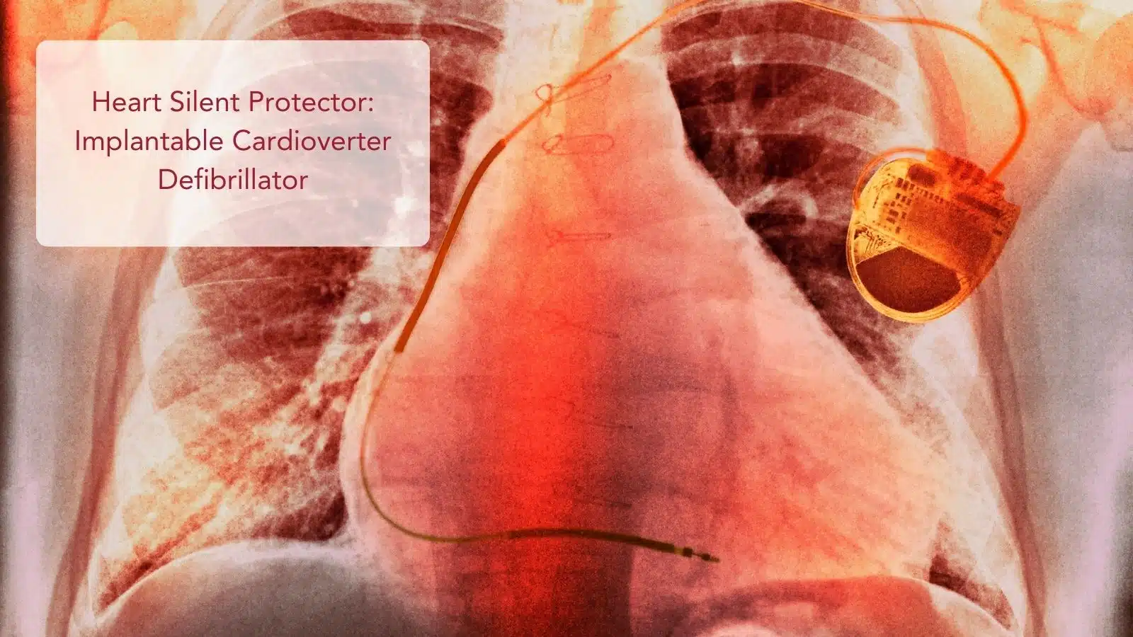 Heart’s Silent Protector: Implantable Cardioverter Defibrillator (ICD)
