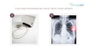 ICDs and Pacemakers What Sets Them Apart