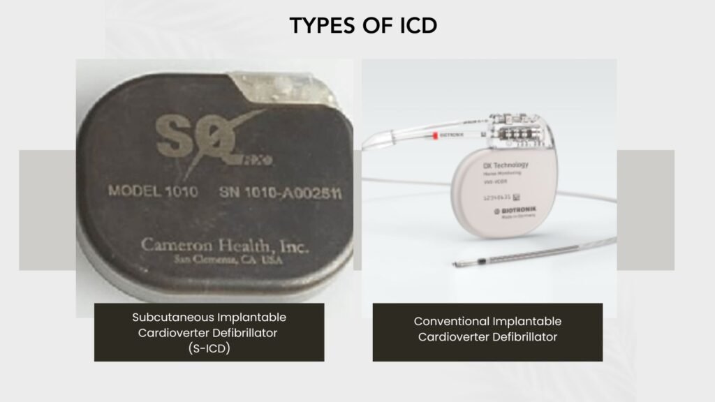 TYPES OF ICD