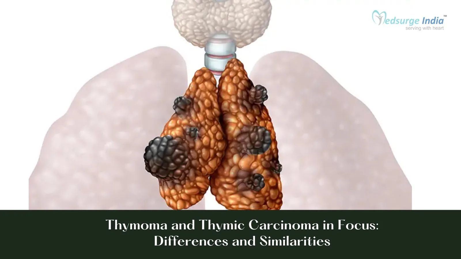 Thymoma and Thymic Carcinoma in Focus: Differences and Similarities