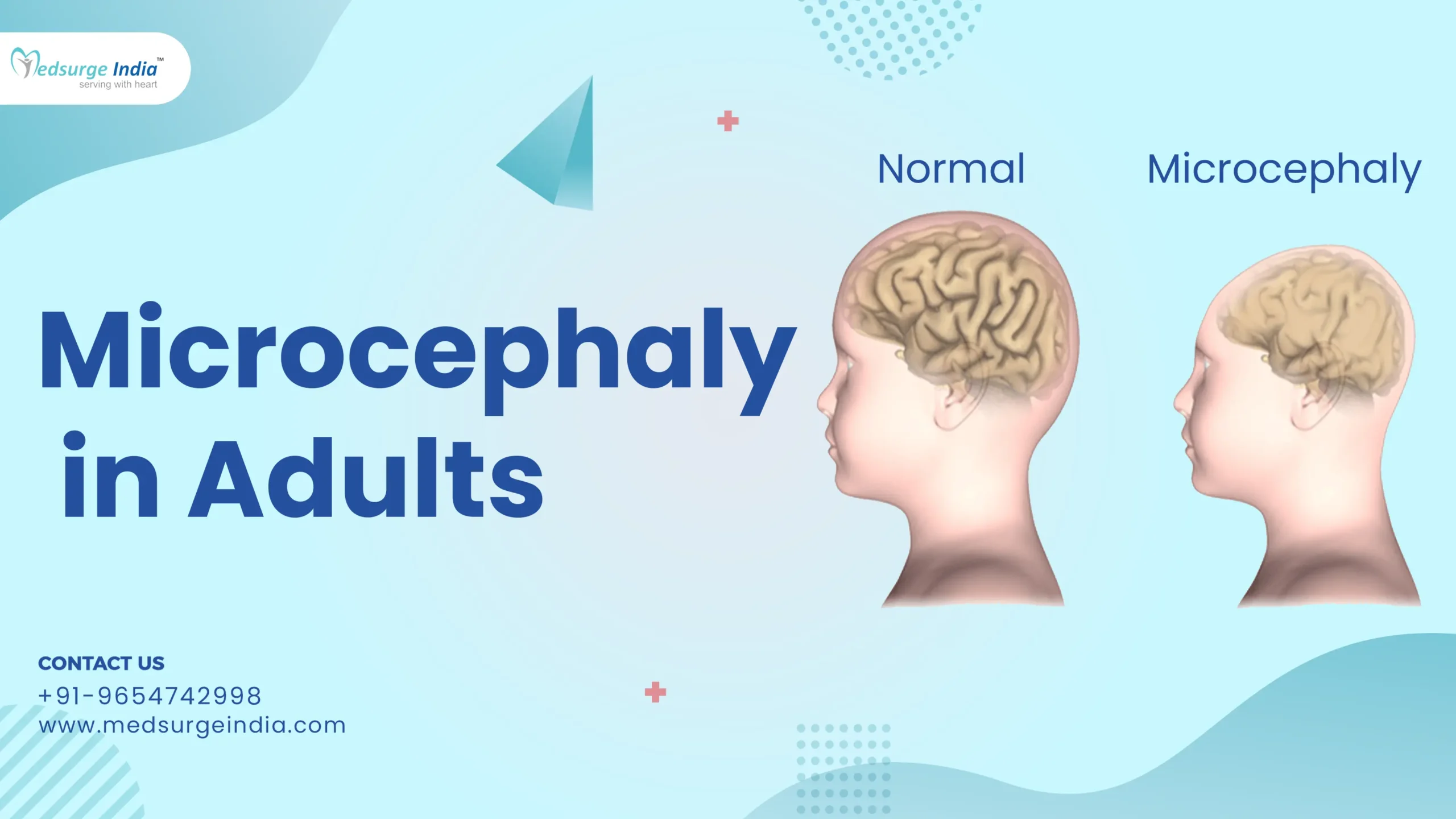 Microcephaly in Adults