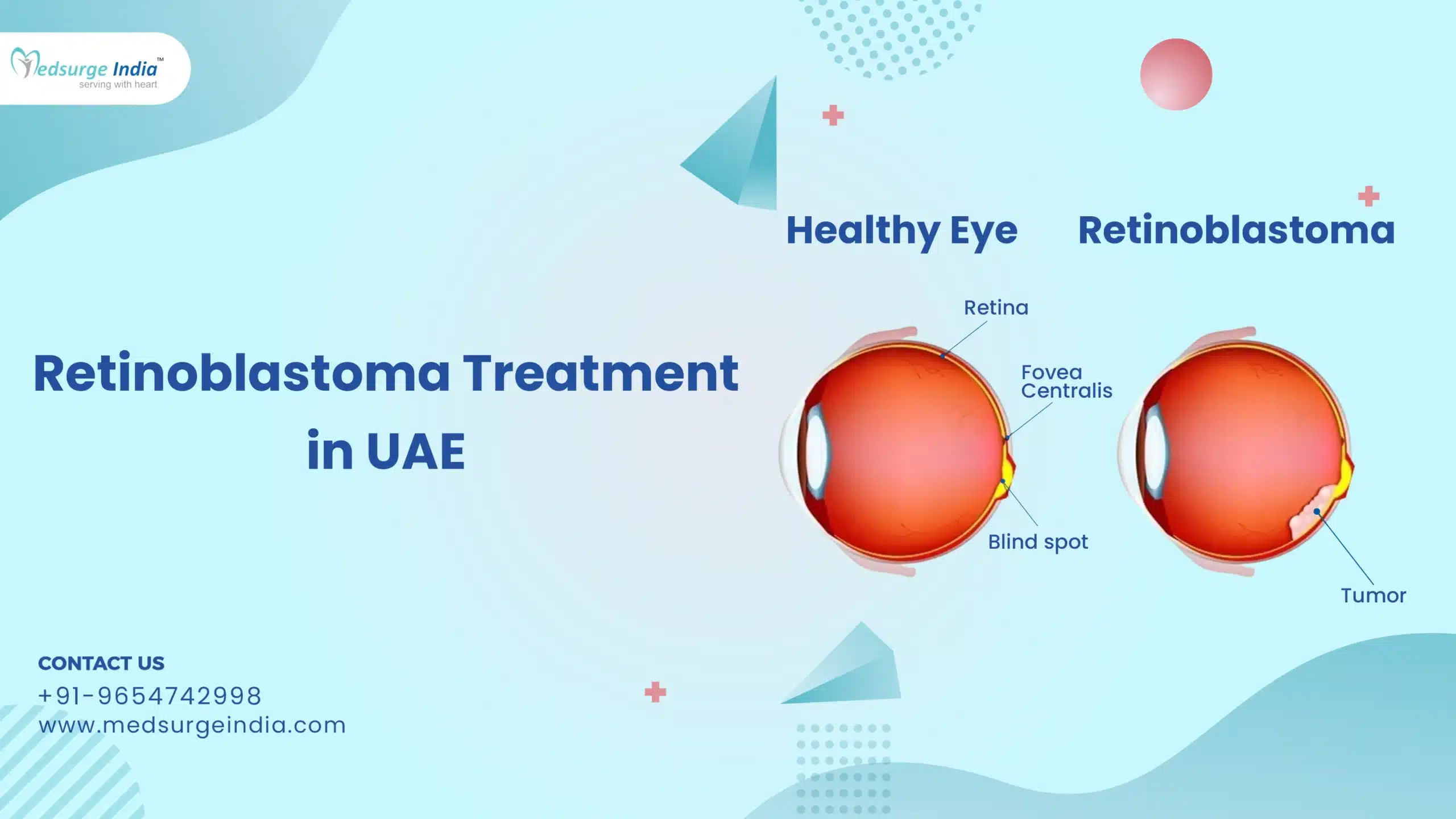 Retinoblastoma Treatment Cost in UAE